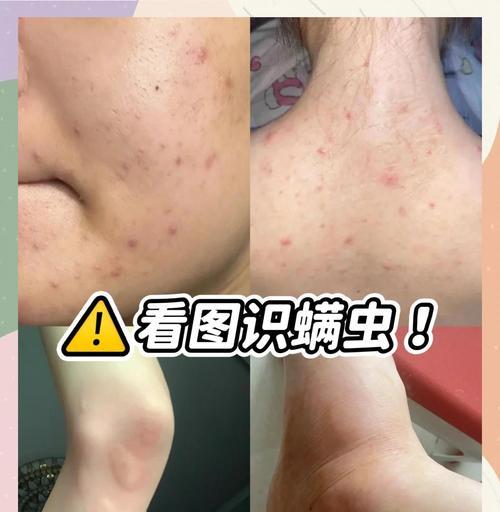 螨虫的检测与防治方法（掌握有效的螨虫检测技巧，保障室内环境清洁卫生）